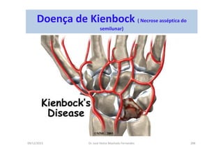 09/12/2015 Dr. José Heitor Machado Fernandes 288
Doença de Kienbock ( Necrose asséptica do
semilunar)
 