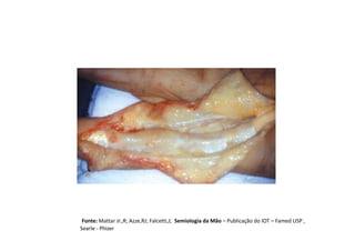 Fonte: Mattar Jr.,R; Azze,RJ; Falcetti,J; Semiologia da Mão – Publicação do IOT – Famed USP ,
Searle - Phizer
 
