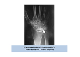 RX mostrando como osso semilunar torna-se
branco e colapsado ( necrose asséptica)
 