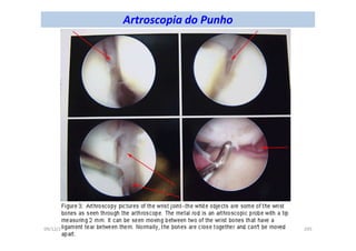 figura
09/12/2015 Dr. José Heitor Machado Fernandes 295
Artroscopia do Punho
 