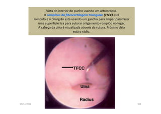 09/12/2015 Dr. José Heitor Machado Fernandes 303
Vista do interior do punho usando um artroscópio.
O complexo da fibrocartilagem triangular (TFCC) está
rompido e o cirurgião está usando um gancho para limpar para fazer
uma superfície lisa para suturar o ligamento rompido no lugar.
A cabeça da ulna é visualizada através da rutura. Próximo dela
está o rádio.
 