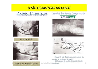 09/12/2015 Dr. José Heitor Machado Fernandes 305
LESÃO LIGAMENTAR DO CARPO
Arcos de Gilula
Quebra dos Arcos de Gilula
 