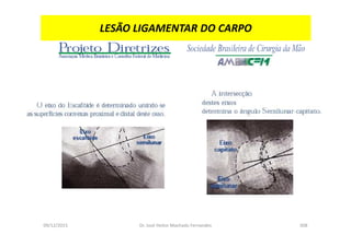09/12/2015 Dr. José Heitor Machado Fernandes 308
LESÃO LIGAMENTAR DO CARPO
 