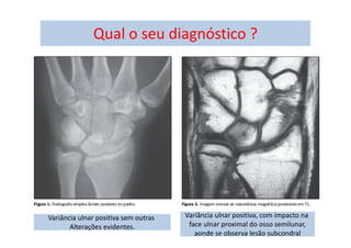 09/12/2015 316
Qual o seu diagnóstico ?
Variância ulnar positiva sem outras
Alterações evidentes.
Variância ulnar positiva, com impacto na
face ulnar proximal do osso semilunar,
aonde se observa lesão subcondral
 