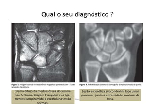 09/12/2015 Dr. José Heitor Machado Fernandes 317
Qual o seu diagnóstico ?
Edema difuso da medula óssea do semilu-
nar. A fibrocartilagem triangular e os liga-
mentos lunopiramidal e escafolunar estão
normais.
Lesão esclerótica subcondral na face ulnar
proximal , junto à extremidade proximal da
Ulna.
 