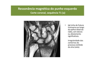Ressonância magnética do punho esquerdo
Corte coronal, sequência T1 (a)
• (a) Linha de fratura
transversa ao longo
da epífise distal do
rádio, sem desvio
ou afastamento
significativos.
Irregularidade dos
contornos do
processo estilóide
da ulna (seta).
 