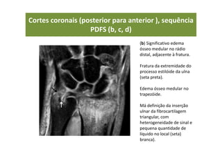 Cortes coronais (posterior para anterior ), sequência
PDFS (b, c, d)
(b) Significativo edema
ósseo medular no rádio
distal, adjacente à fratura.
Fratura da extremidade do
processo estilóide da ulna
(seta preta).
Edema ósseo medular no
trapezóide.
Má definição da inserção
ulnar da fibrocartilagem
triangular, com
heterogeneidade de sinal e
pequena quantidade de
líquido no local (seta)
branca).
 