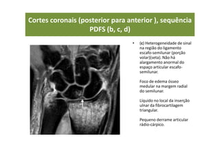 • (c) Heterogeneidade de sinal
na região do ligamento
escafo-semilunar (porção
volar)(seta). Não há
alargamento anormal do
espaço articular escafo-
semilunar.
Foco de edema ósseo
medular na margem radial
do semilunar.
Líquido no local da inserção
ulnar da fibrocartilagem
triangular.
Pequeno derrame articular
rádio-cárpico.
Cortes coronais (posterior para anterior ), sequência
PDFS (b, c, d)
 