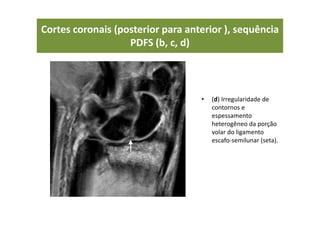 • (d) Irregularidade de
contornos e
espessamento
heterogêneo da porção
volar do ligamento
escafo-semilunar (seta).
Cortes coronais (posterior para anterior ), sequência
PDFS (b, c, d)
 