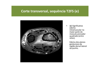 Corte transversal, sequência T2FS (e)
• (e) Significativo
edema
intramuscular na
maior parte do
músculo pronador
quadrado (entre
setas).
Edema dos planos
gordurosos da
região dorsal lateral
do punho.
 