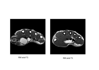 figura
RM axial T1 RM axial T1
 