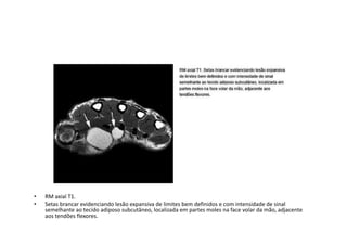 • RM axial T1.
• Setas brancar evidenciando lesão expansiva de limites bem definidos e com intensidade de sinal
semelhante ao tecido adiposo subcutâneo, localizada em partes moles na face volar da mão, adjacente
aos tendões flexores.
 