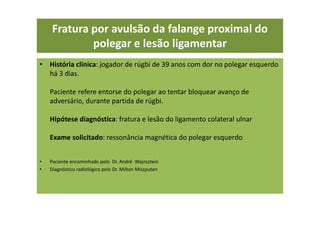 Fratura por avulsão da falange proximal do
polegar e lesão ligamentar
• História clínica: jogador de rúgbi de 39 anos com dor no polegar esquerdo
há 3 dias.
Paciente refere entorse do polegar ao tentar bloquear avanço de
adversário, durante partida de rúgbi.
Hipótese diagnóstica: fratura e lesão do ligamento colateral ulnar
Exame solicitado: ressonância magnética do polegar esquerdo
• Paciente encaminhado pelo Dr. André Wajnsztein
• Diagnóstico radiológico pelo Dr. Milton Miszputen
 