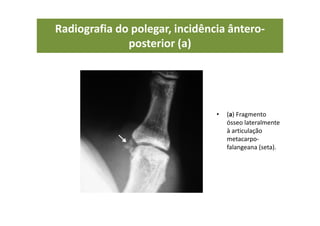 Radiografia do polegar, incidência ântero-
posterior (a)
• (a) Fragmento
ósseo lateralmente
à articulação
metacarpo-
falangeana (seta).
 