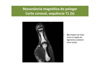 Ressonância magnética do polegar
Corte coronal, sequência T1 (b)
• (b) Imagem de hipo-
sinal na região do
ligamento colateral
ulnar (seta).
 