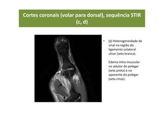 Cortes coronais (volar para dorsal), sequência STIR
(c, d)
• (c) Heterogeneidade de
sinal na região do
ligamento colateral
ulnar (seta branca).
Edema intra-muscular
no adutor do polegar
(seta preta) e no
oponente do polegar
(seta cinza).
 