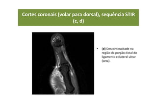• (d) Descontinuidade na
região da porção distal do
ligamento colateral ulnar
(seta).
Cortes coronais (volar para dorsal), sequência STIR
(c, d)
 