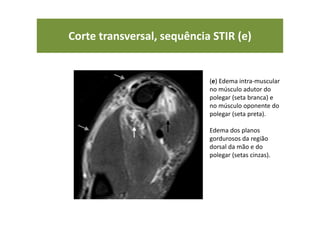 Corte transversal, sequência STIR (e)
• (e) Edema intra-muscular
no músculo adutor do
polegar (seta branca) e
no músculo oponente do
polegar (seta preta).
Edema dos planos
gordurosos da região
dorsal da mão e do
polegar (setas cinzas).
 