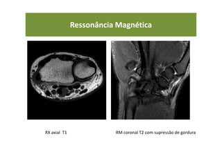Ressonância Magnética
RX axial T1 RM coronal T2 com supressão de gordura
 