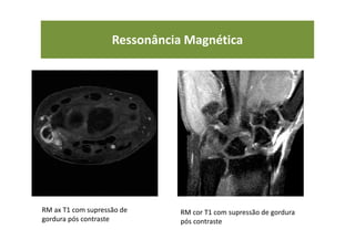 RM ax T1 com supressão de
gordura pós contraste
RM cor T1 com supressão de gordura
pós contraste
Ressonância Magnética
 