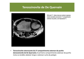 Tenossinovite de De Quervain
• Tenossinovite estenosante do 1º compartimento extensor do punho
(tenossinovite de De Quervain). O primeiro compartimento extensor do punho
inclui os tendões abdutor longo e extensor curto do polegar.
 