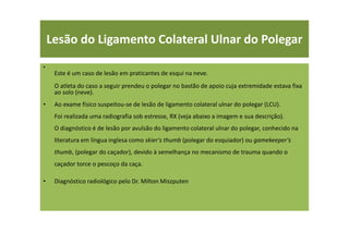 Lesão do Ligamento Colateral Ulnar do Polegar
•
Este é um caso de lesão em praticantes de esqui na neve.
O atleta do caso a seguir prendeu o polegar no bastão de apoio cuja extremidade estava fixa
ao solo (neve).
• Ao exame físico suspeitou-se de lesão de ligamento colateral ulnar do polegar (LCU).
Foi realizada uma radiografia sob estresse, RX (veja abaixo a imagem e sua descrição).
O diagnóstico é de lesão por avulsão do ligamento colateral ulnar do polegar, conhecido na
literatura em língua inglesa como skier's thumb (polegar do esquiador) ou gamekeeper's
thumb, (polegar do caçador), devido à semelhança no mecanismo de trauma quando o
caçador torce o pescoço da caça.
• Diagnóstico radiológico pelo Dr. Milton Miszputen
 