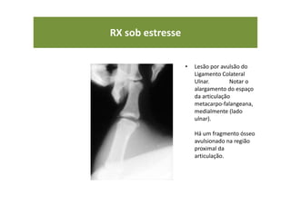 RX sob estresse
• Lesão por avulsão do
Ligamento Colateral
Ulnar. Notar o
alargamento do espaço
da articulação
metacarpo-falangeana,
medialmente (lado
ulnar).
Há um fragmento ósseo
avulsionado na região
proximal da
articulação.
 
