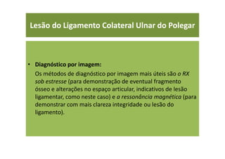 • Diagnóstico por imagem:
Os métodos de diagnóstico por imagem mais úteis são o RX
sob estresse (para demonstração de eventual fragmento
ósseo e alterações no espaço articular, indicativos de lesão
ligamentar, como neste caso) e a ressonância magnética (para
demonstrar com mais clareza integridade ou lesão do
ligamento).
Lesão do Ligamento Colateral Ulnar do Polegar
 