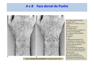 A e B Face Dorsal do Punho
A, complexo da fibrocartilagem
triangular (CFCT);
B, tensão do m. extensor ulnar do
carpo;
C,tubérculo de Lister;
D, estilóide radial;
E, m. abdutor longo do polegar e m.
extensor curto do polegar;
F, m. extensor longo do polegar;
G, escafóide;
H, trapézio;
I. artic.
Escafotrapeziotrapezoide (ETT);
J, tendões do m. extensor radial
curto do carpo e m. extensor radial
longo do carpo; K, ligamento
escafossemilunar;
L, art. Escafossemilunarcapitato;
M, cabeça do capitato; N, tendoões
dos mm. Extensores dos dedos; O,
cabeça da ulna;
P, art. Radioulnar distal;
Q, processo estilóide da ulna;
R, ligamento semilunopiramidal,
S, piramidal; T, hamato; U, semilunar
A e B Face dorsal do Punho
Reider, O Exame Físico em Ortopedia – Guanabara Koogan -2001
 