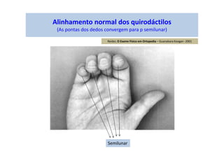 Alinhamento normal dos quirodáctilos
(As pontas dos dedos convergem para p semilunar)
Semilunar
Reider, O Exame Físico em Ortopedia – Guanabara Koogan -2001
 