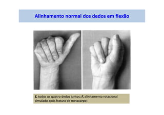 Alinhamento normal dos dedos em flexão
E, todos os quatro dedos juntos; F, alinhamento rotacional
simulado após fratura de metacarpo;
 