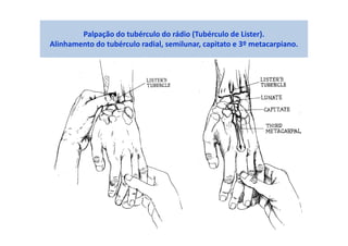 Palpação do tubérculo do rádio (Tubérculo de Lister).
Alinhamento do tubérculo radial, semilunar, capitato e 3º metacarpiano.
 