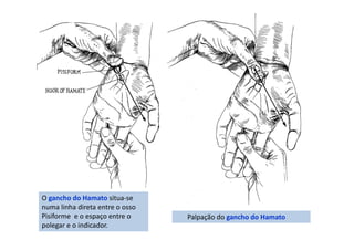 O gancho do Hamato situa-se
numa linha direta entre o osso
Pisiforme e o espaço entre o
polegar e o indicador.
Palpação do gancho do Hamato
 