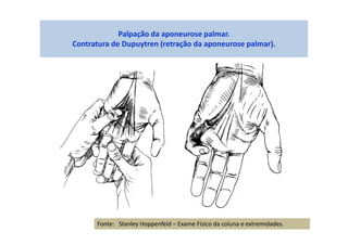 Palpação da aponeurose palmar.
Contratura de Dupuytren (retração da aponeurose palmar).
Fonte: Stanley Hoppenfeld – Exame Físico da coluna e extremidades.
 