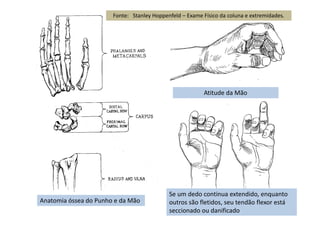 Anatomia óssea do Punho e da Mão
Atitude da Mão
Se um dedo continua extendido, enquanto
outros são fletidos, seu tendão flexor está
seccionado ou danificado
Fonte: Stanley Hoppenfeld – Exame Físico da coluna e extremidades.
 
