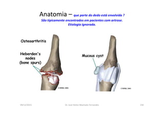 09/12/2015 Dr. José Heitor Machado Fernandes 156
Anatomia – que parte do dedo está envolvida ?
São tipicamente encontrados em pacientes com artrose.
Etiologia ignorada.
 