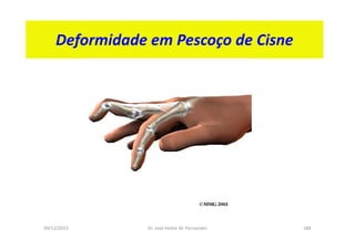09/12/2015 Dr. José Heitor M. Fernandes 188
Deformidade em Pescoço de Cisne
 