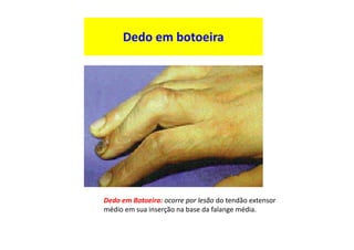 Dedo em botoeira
Dedo em Botoeira: ocorre por lesão do tendão extensor
médio em sua inserção na base da falange média.
 