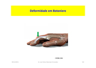 09/12/2015 Dr. José Heitor Machado Fernandes 192
Deformidade em Botoniere
 
