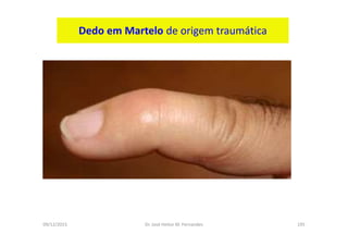 09/12/2015 Dr. José Heitor M. Fernandes 195
Dedo em Martelo de origem traumática
 
