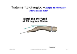 09/12/2015 Dr. José Heitor Machado Fernandes 200
Tratamento cirúrgico – fixação da articulação
interfalângica distal
 