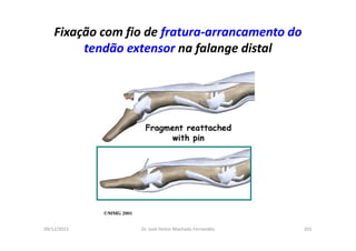 09/12/2015 Dr. José Heitor Machado Fernandes 201
Fixação com fio de fratura-arrancamento do
tendão extensor na falange distal
 