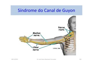 09/12/2015 Dr. José Heitor Machado Fernandes 262
Síndrome do Canal de Guyon
 