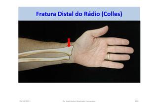 09/12/2015 Dr. José Heitor Machado Fernandes 280
Fratura Distal do Rádio (Colles)
 