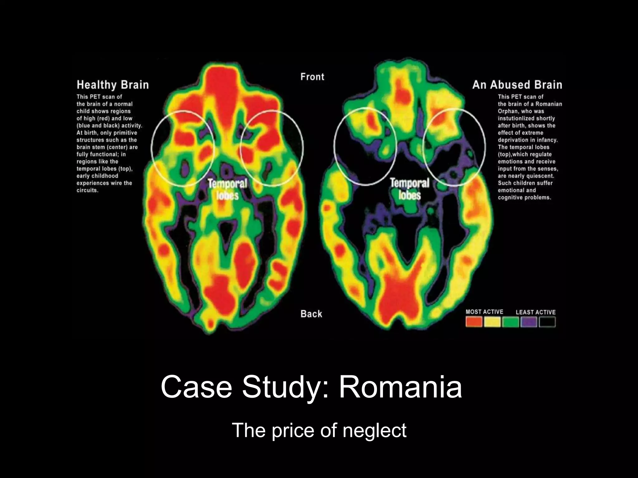 The price of neglect
Nelson CA et al. Science 2007
Case Study: Romania