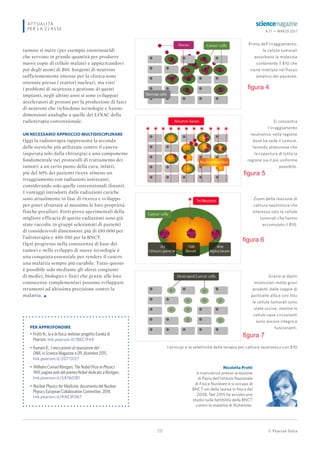 © Pearson Italia
N.17 — MARZO 2017
20
ATTUALITÀ
PER LA CLASSE
tumore si nutre (per esempio amminoacidi
che servono in grande quantità per produrre
nuove copie di cellule malate) e appiccicandovi
poi degli atomi di B10. Sorgenti di neutroni
sufficientemente intense per la clinica sono
ottenute presso i reattori nucleari, ma visti
i problemi di sicurezza e gestione di questi
impianti, negli ultimi anni si sono sviluppati
acceleratori di protoni per la produzione di fasci
di neutroni che richiedono tecnologie e hanno
dimensioni analoghe a quelle dei LINAC della
radioterapia convenzionale.
UN NECESSARIO APPROCCIO MULTIDISCIPLINARE
Oggi la radioterapia rappresenta la seconda
delle tecniche più utilizzate contro il cancro
(superata solo dalla chirurgia) e una componente
fondamentale nei protocolli di trattamento dei
tumori: a un certo punto della cura, infatti,
più del 50% dei pazienti riceve almeno un
irraggiamento con radiazioni ionizzanti,
considerando solo quelle convenzionali (fotoni).
I vantaggi introdotti dalle radiazioni cariche
sono attualmente in fase di ricerca e sviluppo
per poter sfruttare al massimo le loro proprietà
fisiche peculiari. Forti prove sperimentali della
migliore efficacia di queste radiazioni sono già
state raccolte in gruppi selezionati di pazienti
di considerevoli dimensioni: più di 150 000 per
l’adroterapia e 450-550 per la BNCT.
Ogni progresso nella conoscenza di base dei
tumori e nello sviluppo di nuove tecnologie è
una conquista essenziale per rendere il cancro
una malattia sempre più curabile. Tutto questo
è possibile solo mediante gli sforzi congiunti
di medici, biologici e fisici che grazie alle loro
conoscenze complementari possono sviluppare
strumenti ad altissima precisione contro la
malattia. •
I principi e la selettività della terapia per cattura neutronica con B10
Prima dell’irraggiamento,
le cellule tumorali
assorbono la molecola
contenente il B10 che
viene iniettata nel flusso
ematico del paziente.
Zoom della reazione di
cattura neutronica che
interessa solo le cellule
tumorali che hanno
accumulato il B10.
Grazie ai danni
molecolari molto gravi
prodotti dalle coppie di
particelle alfa e ioni litio
le cellule tumorali sono
state uccise, mentre le
cellule sane circostanti
sono ancora integre e
funzionanti.
Si concentra
l’irraggiamento
neutronico nella regione
dove ha sede il tumore,
facendo attenzione che
la copertura di tutta la
regione sia il più uniforme
possibile.
PER APPROFONDIRE
• Protti N., Io e la isica, webinar progetto Eureka di
Pearson. link.pearson.it/1BEC1F44
• Ramani D., I meccanismi di riparazione del
DNA, in Science Magazine n.09, dicembre 2015.
link.pearson.it/2D713127
• Wilhelm Conrad Röntgen, The Nobel Prize in Physics
1901, pagina web del premio Nobel dedicato a Röntgen.
link.pearson.it/5A7601B1
• Nuclear Physics for Medicine, documento del Nuclear
Physics European Collaboration Committee, 2014.
link.pearson.it/AAE3F067
Nicoletta Protti
è ricercatrice presso la sezione
di Pavia dell’Istituto Nazionale
di Fisica Nucleare e si occupa di
BNCT sin dalla laurea in ﬁsica del
2008. Nel 2015 ha avviato uno
studio sulla fattibilità della BNCT
contro la malattia di Alzheimer.
figura 4
figura 5
figura 6
figura 7
 
