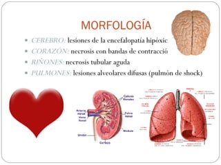 MORFOLOGÍA CEREBRO:  lesiones de la encefalopatía hipóxica CORAZÓN:  necrosis con bandas de contracción RIÑONES:  necrosis tubular aguda PULMONES:  lesiones alveolares difusas (pulmón de shock) 
