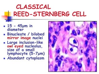 CLASSICAL
REED-STERNBERG CELL
 15 - 45µm in
diameter
 Binucleate / bilobed
mirror image nuclei
 Large inclusion-like
owl eyed nucleolus,
size of a small
lymphocyte (5-7µm)
 Abundant cytoplasm
 