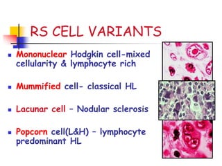 RS CELL VARIANTS
 Mononuclear Hodgkin cell-mixed
cellularity & lymphocyte rich
 Mummified cell- classical HL
 Lacunar cell – Nodular sclerosis
 Popcorn cell(L&H) – lymphocyte
predominant HL
 