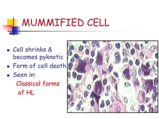 MUMMIFIED CELL
 Cell shrinks &
becomes pyknotic
 Form of cell death
 Seen in:
Classical forms
of HL
 